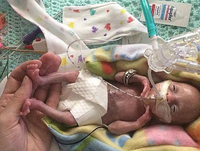 Bé Lyla lúc mới sinh khi được 21 tuần 4 ngày - là em bé sinh non nhỏ nhất thế giới được cứu sống khỏe mạnh - Ảnh: Courtney Stensrud