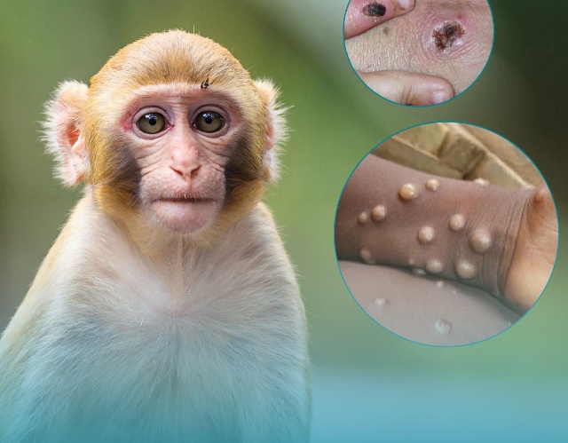 Bộ Y tế hướng dẫn chẩn đoán, điều trị và phòng bệnh đậu mùa khỉ - Ảnh 1.