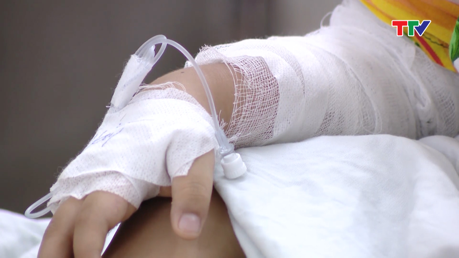  Từ đầu mùa hè đến nay số lượng bệnh nhân bị bỏng, nhất là bỏng cồn tăng hơn so với bình thường.