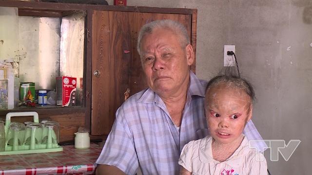 Ông Ngô Ngọc Dũng- Thôn Yên Lộc, xã Thiệu Vũ, huyện Thiệu Hóa:  &quot;Tôi tham gia chiến đấu tại vùng Mỹ rải chất độc hóa học, con trai tôi đã mất, cháu cũng bị dị dạng nhưng đến nay chưa được giải quyết chế độ. Đề nghị Nhà nước xem xét giải quyết chế độ cho cháu &quot;