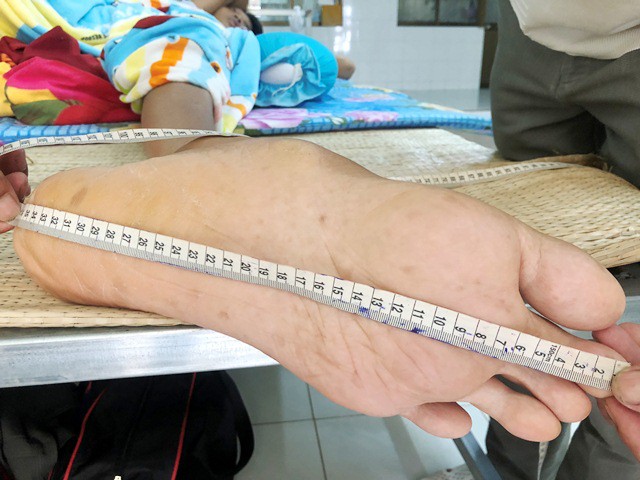 Với th&acirc;n h&igrave;nh qu&aacute; khổ, b&agrave;n tay, ch&acirc;n của anh Trung cũng to hơn b&igrave;nh thường. Gia đ&igrave;nh đ&atilde; phải thu&ecirc; người l&agrave;m chiếc giường ri&ecirc;ng để anh Trung nằm trị bệnh.