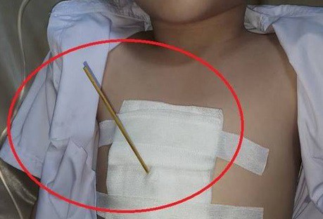 C&acirc;y xi&ecirc;n c&aacute; vi&ecirc;n đ&acirc;m v&agrave;o lồng ngực bệnh nhi (ảnh: bệnh viện cung cấp)