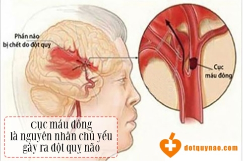 Nhồi m&aacute;u n&atilde;o do cục m&aacute;u đ&ocirc;ng l&agrave; một dạng thường gặp nhất của cơn đột quỵ n&atilde;o