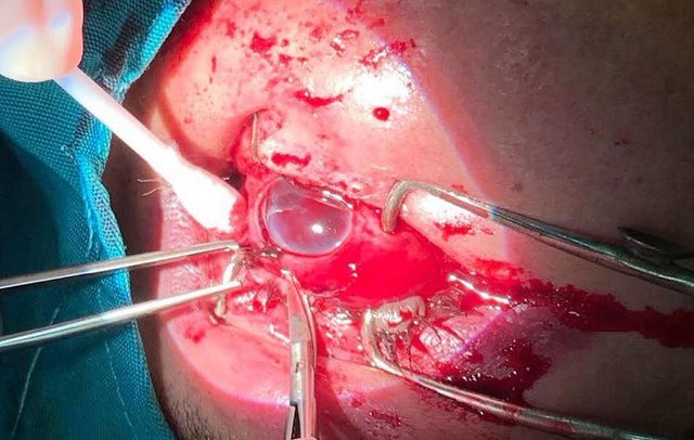 Các bác sĩ tiến hành múc nội nhãn cho bệnh nhân.