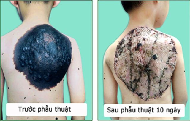 U hắc tố là dạng hiếm gặp, cần phẫu thuật để tránh nguy cơ hóa u ác tính
