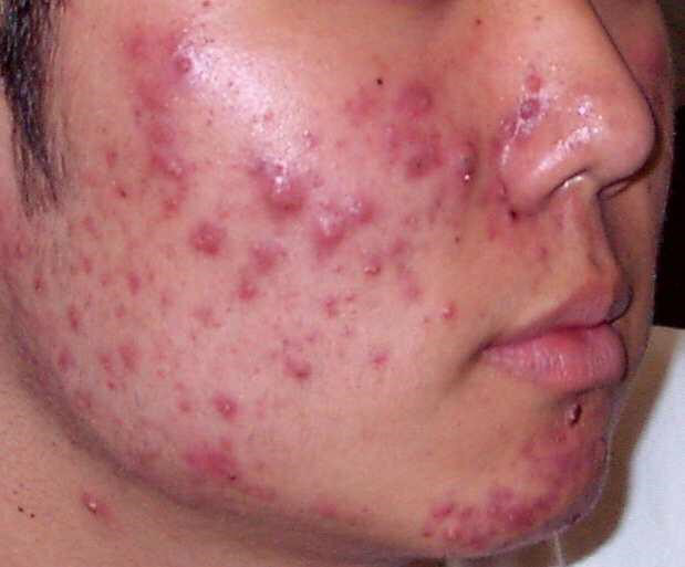 Mụn trứng cá ảnh hưởng lớn đến thẩm mỹ