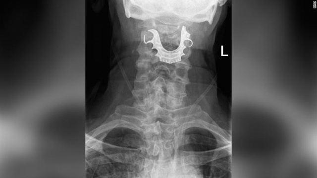Hình chụp X-quang cổ họng bệnh nhân cho thấy vật thể hình bán nguyệt mắc ngang cổ họng. Ảnh: CNN