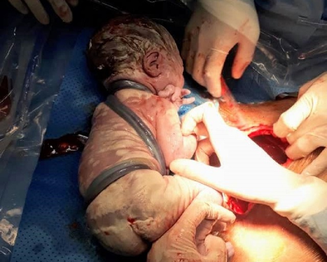 Bé trai chào đời với 6 vòng dây rốn quấn chặt quanh cơ thể