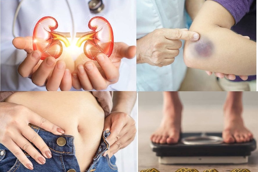 Một số dấu hiệu cảnh báo bệnh xơ gan. Ảnh minh hoạ: Nhật Quang.