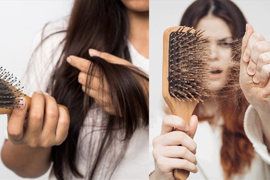 Rụng tóc quá nhiều ở tuổi thiếu niên nên khắc phục như thế nào?