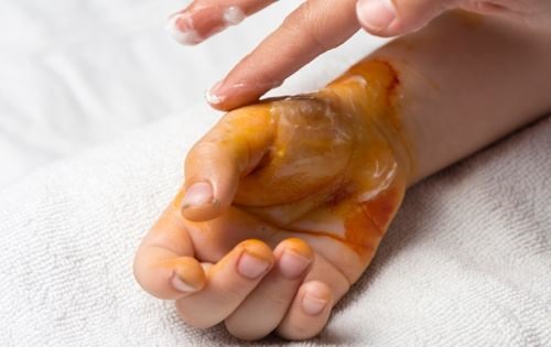 Hướng dẫn cách xử trí khi trẻ bị bỏng điện. Ảnh: Cartermario