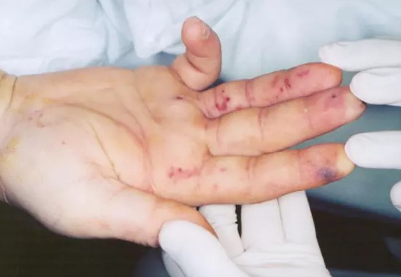 Nốt Osler trên tay bệnh nhân. Ảnh: Grepmed