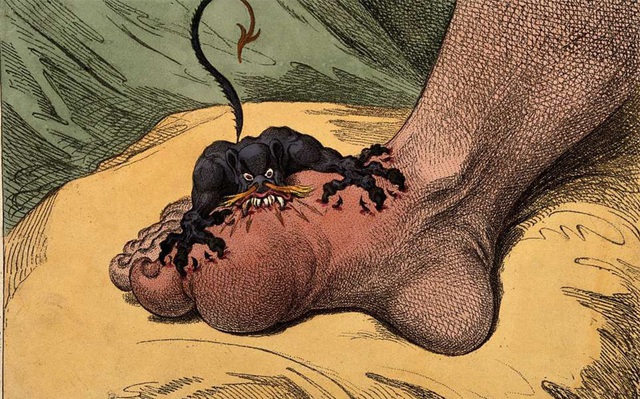 Những căn bệnh &ldquo;cổ xưa&rdquo; đang quay trở lại ở Anh - 1