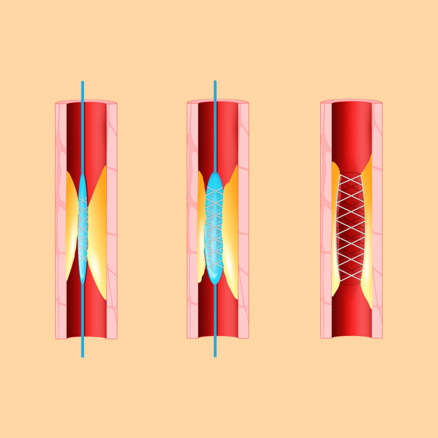 Stent tim: Đặt hay không đặt? - 1 Stent tim: Đặt hay không đặt? - 1