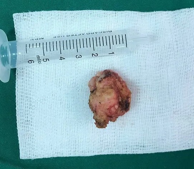 Bác sĩ “lôi” khối u xơ vú 2cm ra khỏi ngực bệnh nhân không để lại dấu vết sẹo - 1 Bác sĩ “lôi” khối u xơ vú 2cm ra khỏi ngực bệnh nhân không để lại dấu vết sẹo - 1