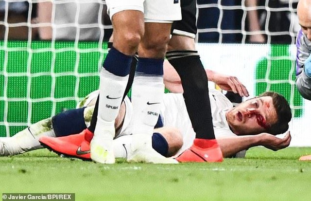 Vertonghen đổ máu trong ngày Tottenham bại trận trước Ajax - 4 Vertonghen đổ máu trong ngày Tottenham bại trận trước Ajax - 4