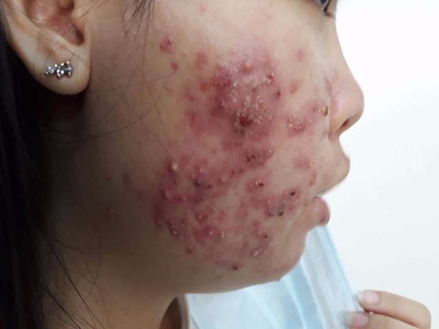 K&yacute; sinh tr&ugrave;ng đ&agrave;o hang khiến da mặt như bị mụn trứng c&aacute; - 1
