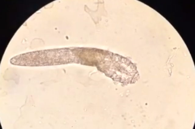 K&yacute; sinh tr&ugrave;ng đ&agrave;o hang khiến da mặt như bị mụn trứng c&aacute; - 2