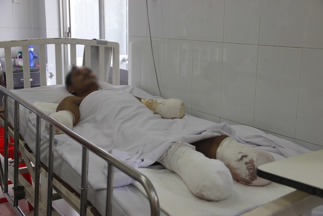 Liên tiếp 2 trường hợp phải đoạn tứ chi vì bỏng điện - 1 Liên tiếp 2 trường hợp phải đoạn tứ chi vì bỏng điện - 1