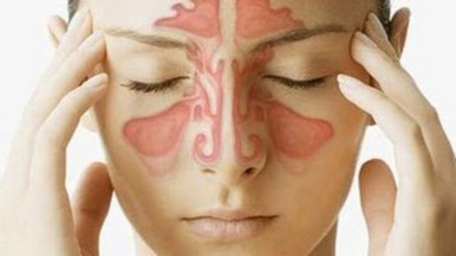 Có thuốc trị dứt điểm bệnh viêm xoang? - 1 Có thuốc trị dứt điểm bệnh viêm xoang? - 1