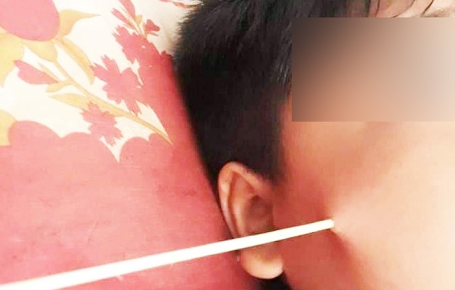 Học sinh bị xiên que đâm thủng mặt ở sân trường - 1 Học sinh bị xiên que đâm thủng mặt ở sân trường - 1