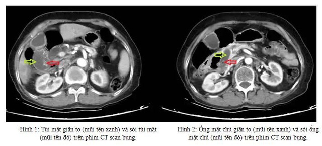 Cảnh giác với biểu hiện đau bụng ở người cao tuổi - 1 Cảnh giác với biểu hiện đau bụng ở người cao tuổi - 1