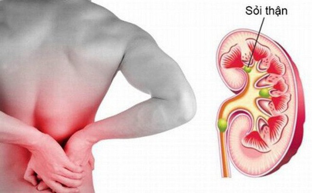 6 dấu hiệu cảnh báo sỏi thận và cách phòng ngừa - 1 6 dấu hiệu cảnh báo sỏi thận và cách phòng ngừa - 1