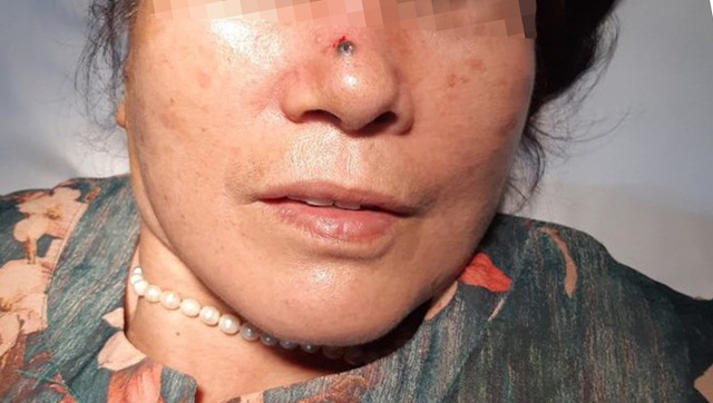 Tưởng nốt ruồi bình thường hóa ung thư da - 1 Tưởng nốt ruồi bình thường hóa ung thư da - 1