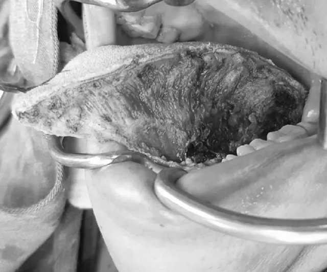 Nhiều người bỗng nhi&ecirc;n phải cắt lưỡi v&igrave; ung thư - 1