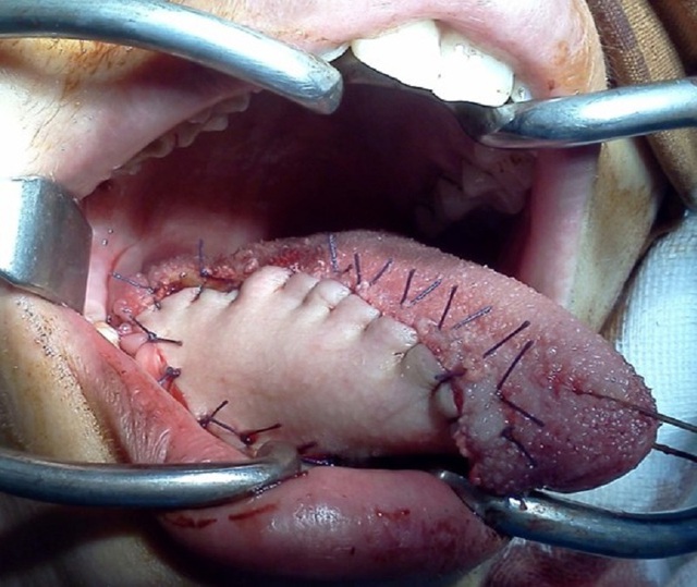 Lưỡi bị ung thư sau khi cắt được bác sĩ tái tạo như thế nào? - 2