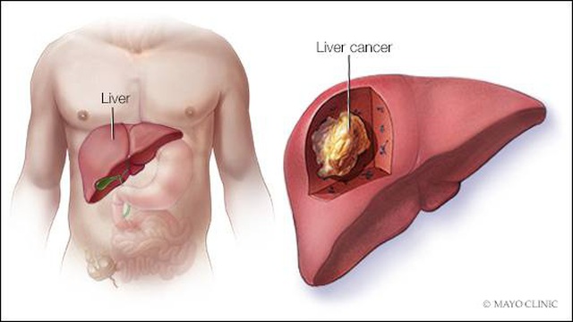 7 điều cần làm nếu muốn tránh ung thư gan - 1 7 điều cần làm nếu muốn tránh ung thư gan - 1
