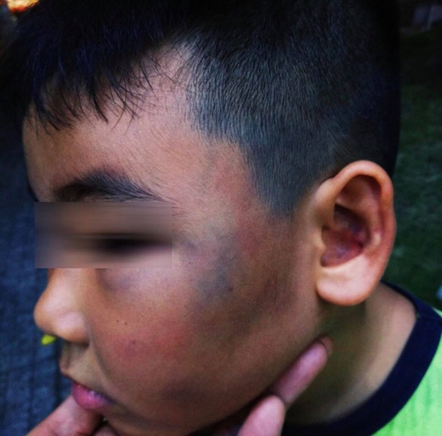 Bé 8 tuổi bị đánh bầm tím mặt vì nghịch đàn gà - 1 Bé 8 tuổi bị đánh bầm tím mặt vì nghịch đàn gà - 1