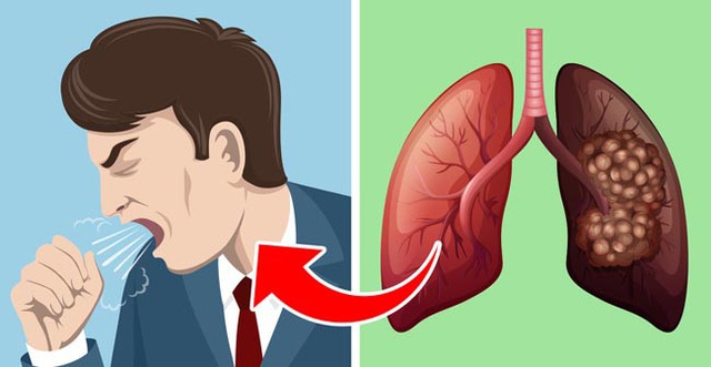 5 triệu chứng ung thư phổi nhiều người kh&ocirc;ng hề hay biết - 2