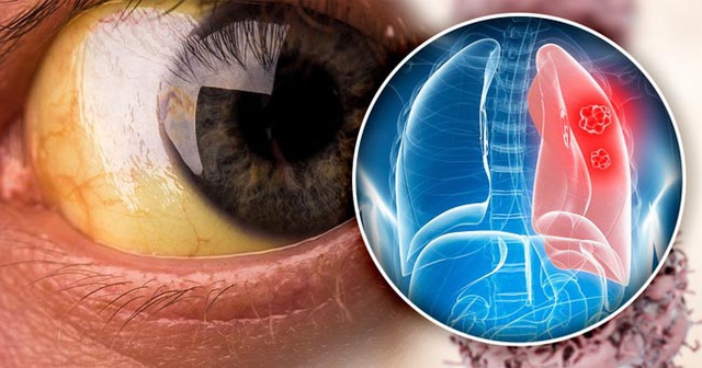 5 triệu chứng ung thư phổi nhiều người kh&ocirc;ng hề hay biết - 4