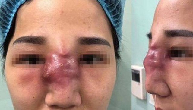 Biến chứng đáng sợ của tiêm filler ai cũng cần biết trước khi làm đẹp - 1 Biến chứng đáng sợ của tiêm filler ai cũng cần biết trước khi làm đẹp - 1
