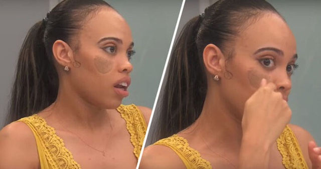 Thảm họa phẫu thuật thẩm mỹ: Lấy da vùng kín ghép lên mặt và cái kết đắng - 2