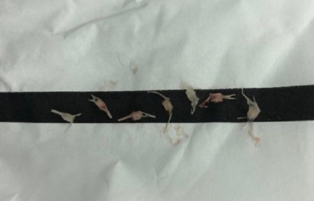 Người nhà sơ ý, 7 đốt xương cá sặc vào phổi bé gái - 1 Người nhà sơ ý, 7 đốt xương cá sặc vào phổi bé gái - 1