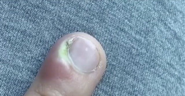 C&ocirc; g&aacute;i 18 tuổi su&yacute;t phải cắt cụt ng&oacute;n tay v&igrave; th&oacute;i quen nhiều người mắc phải - 1