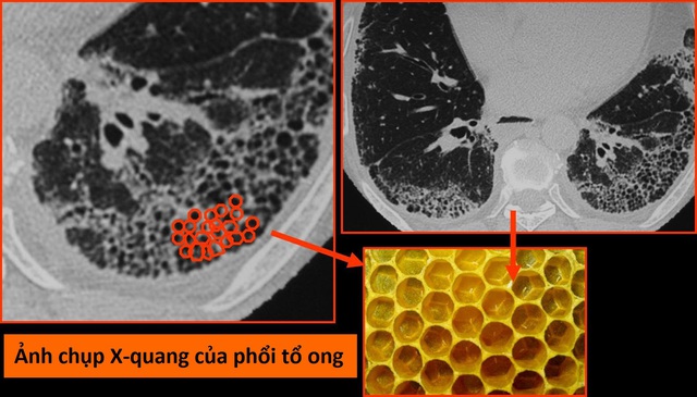 Virus corona mới tàn phá các bộ phận trên cơ thể như thế nào? - 3 Virus corona mới tàn phá các bộ phận trên cơ thể như thế nào? - 3