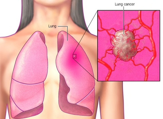 Bệnh nhân ung thư phổi sống được bao lâu? - 1