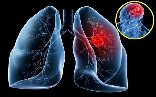 Ung thư phổi: Nguyên nhân, triệu chứng của bệnh - 1
