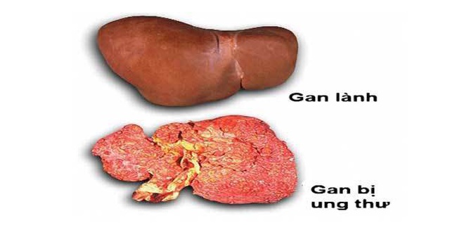 Triệu chứng 2 giảm, 2 đau trên cơ thể, báo hiệu ung thư gan tới gần - 1 Triệu chứng 2 giảm, 2 đau trên cơ thể, báo hiệu ung thư gan tới gần - 1