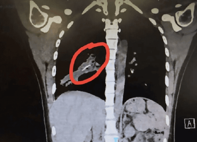 Ho dai dẳng 14 năm vì xương gà nằm trong phổi - 1