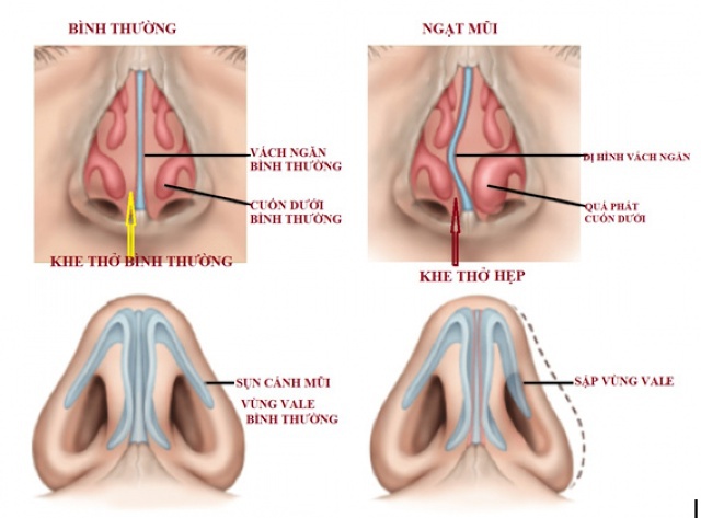 Không nên tùy tiện dùng thuốc để trị ngạt mũi