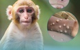 Bộ Y tế hướng dẫn chẩn đoán, điều trị và phòng bệnh đậu mùa khỉ
