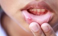 Miệng xuất hiện những dấu hiệu này có thể cảnh báo ung thư