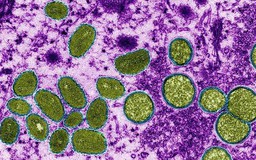 WHO đặt tên mới cho các chủng virus gây bệnh đậu mùa khỉ