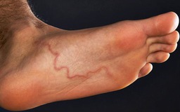 Chủ động phòng chống bệnh giun rồng