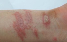 Những sai lầm trong điều trị tổn thương do kiến ba khoang cắn