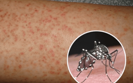 6 dấu hiệu cảnh báo nguy hiểm của bệnh sốt xuất huyết